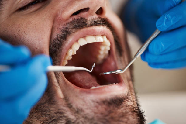 Best Emergency Wisdom Tooth Extraction in Madison, OH